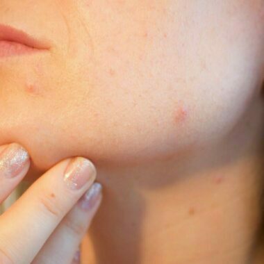 Peaux mixtes, Grasses, Acné et imperfections
