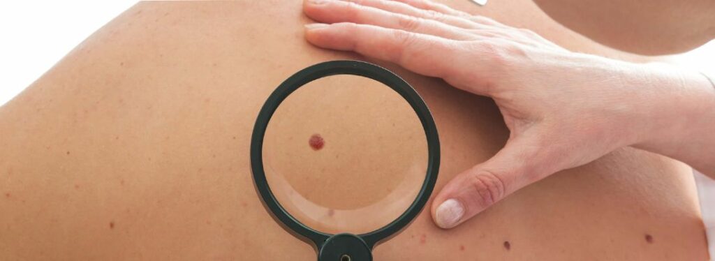 Comment protéger les taupes au soleil ?